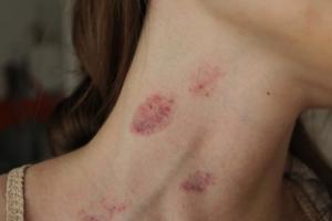 Vết cắn yêu hickey có nguy hiểm không, làm mờ bằng cách nào?