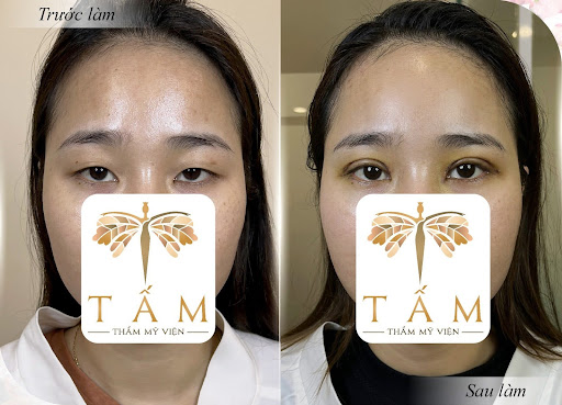 Hành trình “lột xác” mắt to tròn sau cắt mí với Bác sĩ Nick Dương